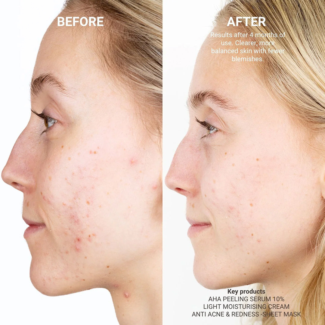 Anti Acne & Redness
