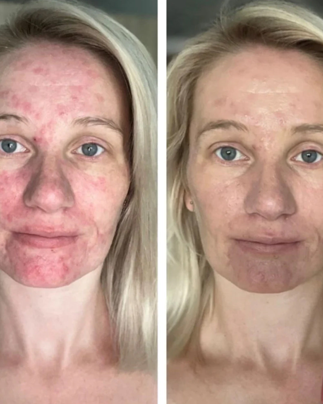 5 in 1 Anti-Redness Day Cream SPF50
